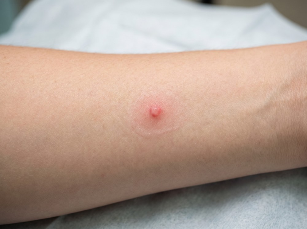 Close-up photograph of a small mild red bump bite mark on skin resembling an ordinary insect bite with no distinct pattern